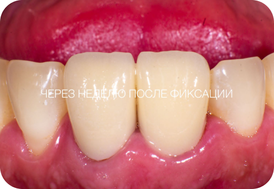 После лечения, пример 1